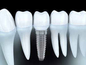 Dental implants in the 60655 area work to replace missing teeth. Learn from Dr. Joe McCartin reasons why they are the best tooth replacement options. 